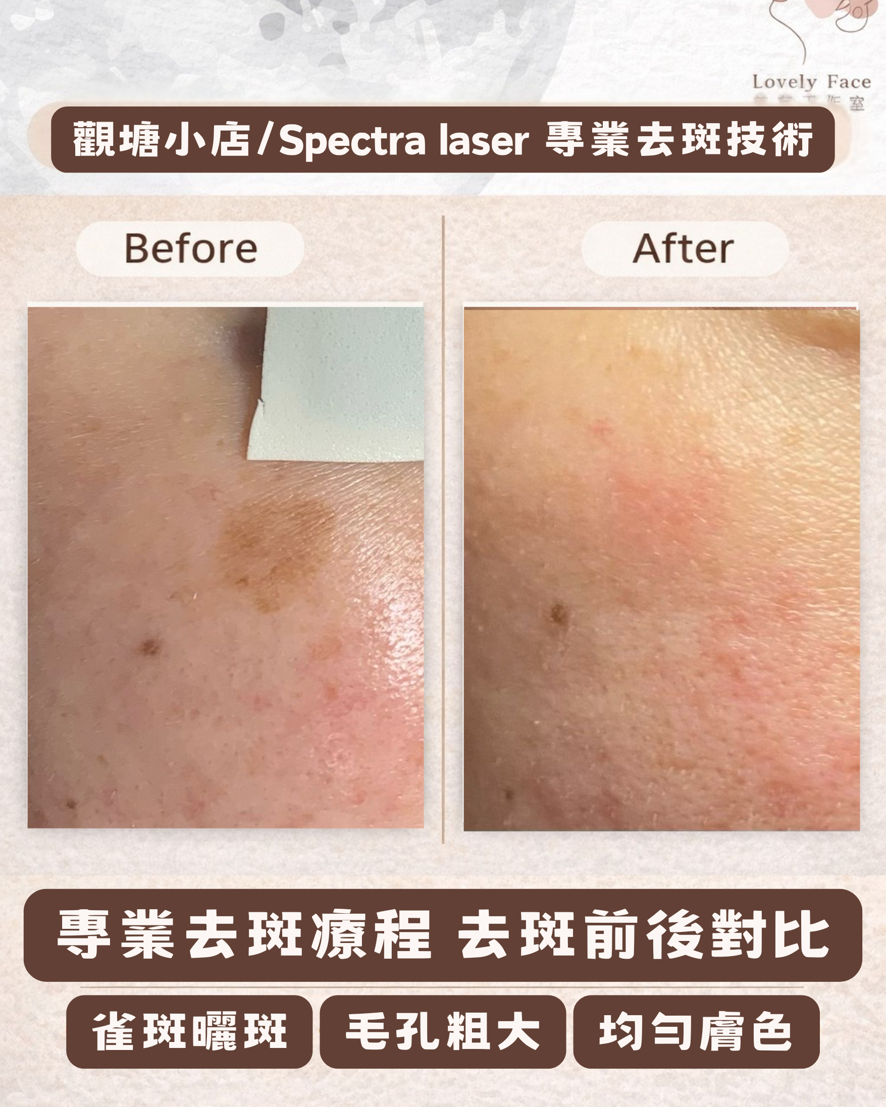 色斑改善前後對比